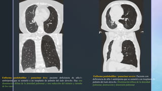 Enfisema Patrones Tomogr ficos pptx Enfisema Patrones Tomogr ficos pptx