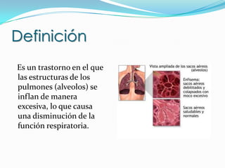 Definición   Es un trastorno en el que las estructuras de los pulmones (alveolos) se inflan de manera excesiva, lo que causa una disminución de la función respiratoria.