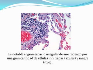 Es notable el gran espacio irregular de aire rodeado por una gran cantidad de células infiltradas (azules) y sangre (rojo). 