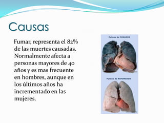 Causas   Fumar, representa el 82% de las muertes causadas. Normalmente afecta a personas mayores de 40 años y es mas frecuente en hombres, aunque en los últimos años ha incrementado en las mujeres.