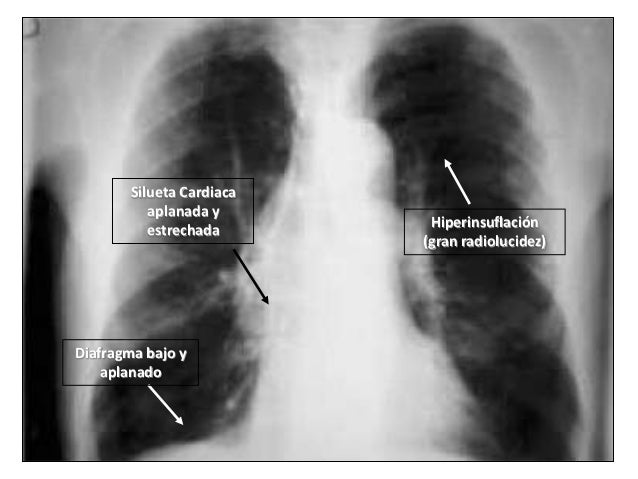 Enfisema pulmonar