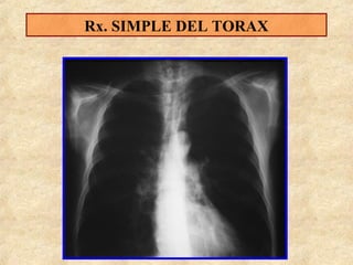 Rx. SIMPLE DEL TORAX

 