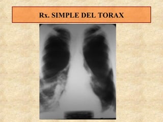 Rx. SIMPLE DEL TORAX

 