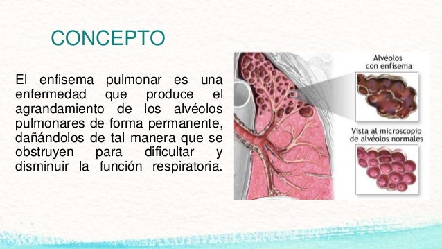 Resultado de imagen para Enfisema