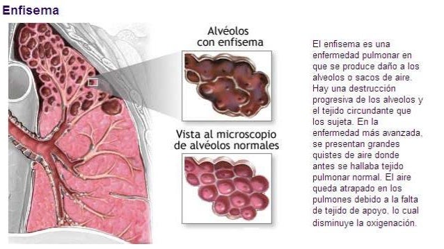 Enfisema pulmonar