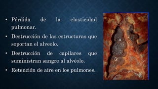 • Pérdida de la elasticidad
pulmonar.
• Destrucción de las estructuras que
soportan el alveolo.
• Destrucción de capilares que
suministran sangre al alvéolo.
• Retención de aire en los pulmones.
 
