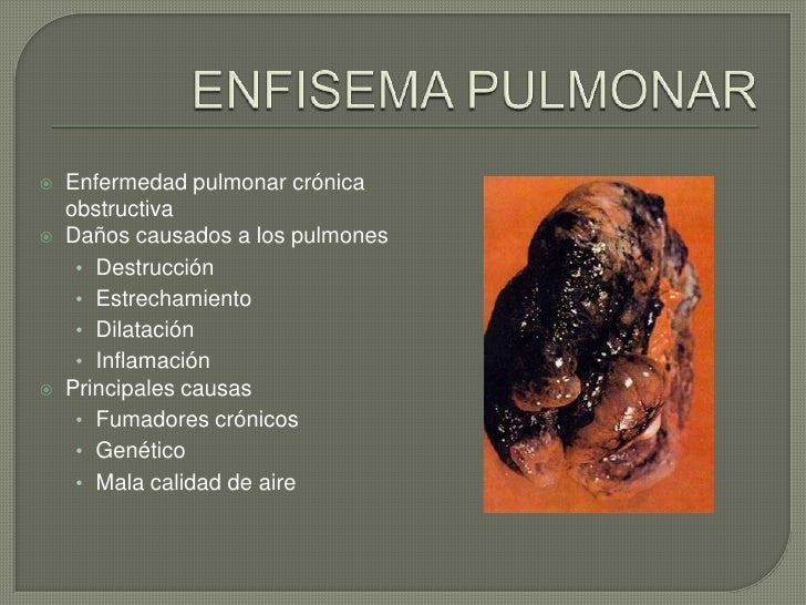 Enfisema pulmonar 2