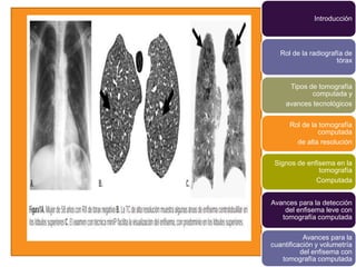 Introducción



   Rol de la radiografía de
                      tórax


      Tipos de tomografía
             computada y
     avances tecnológicos


      Rol de la tomografía
               computada
        de alta resolución


 Signos de enfisema en la
               tomografía
              Computada


Avances para la detección
    del enfisema leve con
   tomografía computada

           Avances para la
cuantificación y volumetría
          del enfisema con
   tomografía computada
 