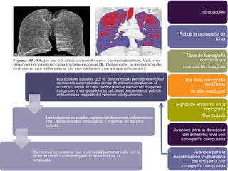 Introducción



                                                                                    Rol de la radiografía de
                                                                                                       tórax


                                                                                       Tipos de tomografía
                                                                                              computada y
                                                                                      avances tecnológicos

             Los software actuales (por ej. density mask) permiten identificar         Rol de la tomografía
             de manera automática las zonas de enfisema, evaluando el                           computada
             contenido aéreo de cada píxel/voxel que forman las imágenes.
             Luego con la computadora se calcula el porcentaje de pulmón                 de alta resolución
             enfisematoso respecto del volumen total pulmonar.

                                                                                  Signos de enfisema en la
                                                                                                tomografía
       Las imágenes se pueden representar de manera tridimensional                             Computada
       (3D), destacando las zonas sanas y enfermas en distintos
       colores.
                                                                                 Avances para la detección
                                                                                     del enfisema leve con
                                                                                    tomografía computada

Es necesario mencionar que la densidad pulmonar varía con la                                Avances para la
edad, el tamaño pulmonar y el tipo de técnica de TC                              cuantificación y volumetría
empleada.                                                                                  del enfisema con
                                                                                    tomografía computada
 