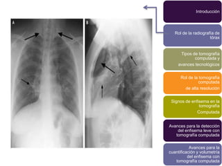 Introducción



   Rol de la radiografía de
                      tórax


      Tipos de tomografía
             computada y
     avances tecnológicos


      Rol de la tomografía
               computada
        de alta resolución


 Signos de enfisema en la
               tomografía
              Computada


Avances para la detección
    del enfisema leve con
   tomografía computada

           Avances para la
cuantificación y volumetría
          del enfisema con
   tomografía computada
 