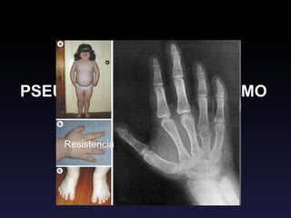 PSEUDOHIPOPARATIROIDISMO
Resistencia a PTH en órgano blanco
 