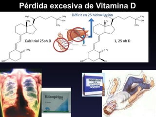 1, 25 oh D
Calcitriol 25oh D
Pérdida excesiva de Vitamina D
Déficit en 25 hidroxilación
 