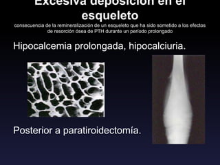 Excesiva deposición en el
esqueleto
consecuencia de la remineralización de un esqueleto que ha sido sometido a los efectos
de resorción ósea de PTH durante un período prolongado
Hipocalcemia prolongada, hipocalciuria.
Posterior a paratiroidectomía.
 