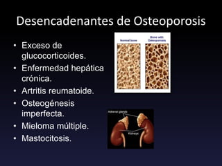 Desencadenantes de Osteoporosis
• Exceso de
glucocorticoides.
• Enfermedad hepática
crónica.
• Artritis reumatoide.
• Osteogénesis
imperfecta.
• Mieloma múltiple.
• Mastocitosis.
 