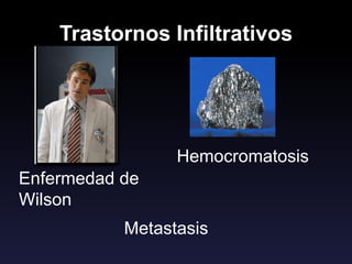 Trastornos Infiltrativos
Hemocromatosis
Enfermedad de
Wilson
Metastasis
 