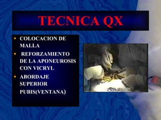 TECNICA QX COLOCACION DE MALLA REFORZAMIENTO DE LA APONEUROSIS CON VICRYL ABORDAJE SUPERIOR PUBIS(VENTANA ) 