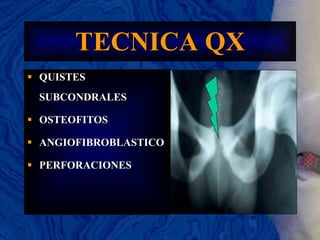 TECNICA QX QUISTES SUBCONDRALES OSTEOFITOS ANGIOFIBROBLASTICO PERFORACIONES 
