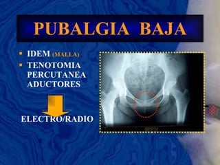 PUBALGIA  BAJA IDEM  (MALLA) TENOTOMIA PERCUTANEA ADUCTORES ELECTRO/RADIO 