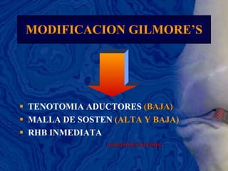MODIFICACION GILMORE’S TENOTOMIA ADUCTORES  (BAJA) MALLA DE SOSTEN  (ALTA Y BAJA) RHB INMEDIATA (GRUPO DE ESTUDIO) 