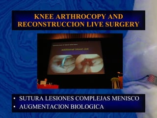 KNEE ARTHROCOPY AND RECONSTRUCCION LIVE SURGERY SUTURA LESIONES COMPLEJAS MENISCO AUGMENTACION BIOLOGICA 