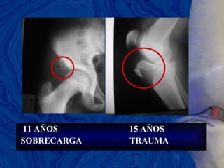 11 AÑOS  15 AÑOS SOBRECARGA  TRAUMA 