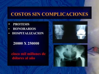 COSTOS SIN COMPLICACIONES   PROTESIS HONORARIOS HOSPITALIZACION 20000 X 250000 cinco mil millones de dólares al año 