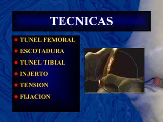 TECNICAS TUNEL FEMORAL ESCOTADURA TUNEL TIBIAL INJERTO TENSION FIJACION 