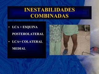 INESTABILIDADES COMBINADAS LCA + ESQUINA POSTEROLATERAL LCA+ COLATERAL MEDIAL 