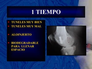1 TIEMPO TUNELES MUY BIEN TUNELES MUY MAL ALOINJERTO BIODEGRADABLE PARA  LLENAR ESPACIO 