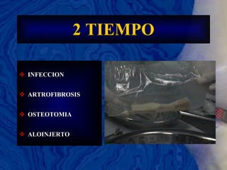 2 TIEMPO INFECCION ARTROFIBROSIS OSTEOTOMIA ALOINJERTO 