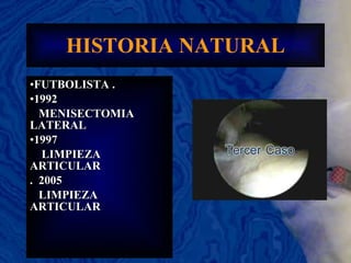 HISTORIA NATURAL FUTBOLISTA . 1992 MENISECTOMIA LATERAL 1997 LIMPIEZA ARTICULAR .  2005 LIMPIEZA  ARTICULAR 