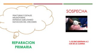 FRACTURAS COSTALES
NEUMOTORAX
ENFISEMA SUBCUTANEO
ELEVACION DEL CRICOIDES
SOSPECHA
¾ SE ENCUENTRAN A 2
CM DE LA CARINAREPARACION
PRIMARIA
 