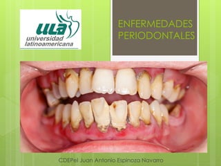 ENFERMEDADES
PERIODONTALES
CDEPeI Juan Antonio Espinoza Navarro
 