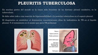 PLEURITIS TUBERCULOSA
En muchas partes del mundo es la causa más frecuente de un derrame pleural exudativo, es la
tuberculosis.
Se debe sobre todo a una reacción de hipersensibilidad a la proteína tuberculosa en el espacio pleural.
El diagnóstico se estabelece al demonstrar concentraciones altas de indicadores de TB en el líquido
pleural. Y el tratamiento es el mismo que para TB pulmonar.
 