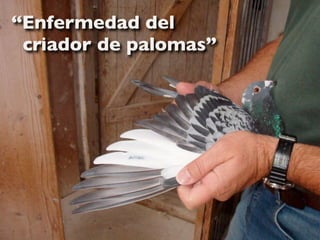 “Enfermedad del
 criador de palomas”
 