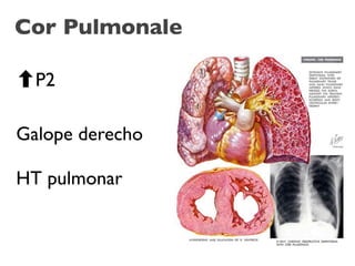 Cor Pulmonale

  P2

Galope derecho

HT pulmonar
 