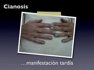 Cianosis




     …manifestación tardía
 