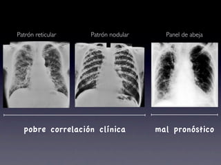 Patrón reticular   Patrón nodular     Panel de abeja




  pobre correlación clínica         mal pronóstico
 