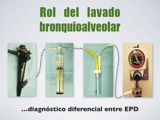 …diagnóstico diferencial entre EPD
 