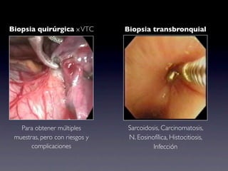 Biopsia quirúrgica x VTC        Biopsia transbronquial




   Para obtener múltiples       Sarcoidosis, Carcinomatosis,
 muestras, pero con riesgos y   N. Eosinofílica, Histocitiosis,
       complicaciones                    Infección
 