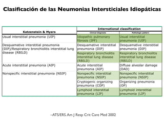 Print   |   Bac
Clasiﬁcación de las Neumonias Intersticiales Idiopáticas
©2009 UpToDate ®
Classification of idiopathic interstitial pneumonias
                                                                                 International classification
                 Katzenstein & Myers                                     Clinical diagnosis                 Pathologic pattern

Usual interstitial pneumonia (UIP)                            Idiopathic pulmonary                Usual interstitial
                                                              fibrosis (IPF)                      pneumonia (UIP)
Desquamative interstitial pneumonia                           Desquamative interstitial           Desquamative interstitial
(DIP)/Respiratory bronchiolitis interstitial lung             pneumonia (DIP)                     pneumonia (DIP)
disease (RBILD)                                               Respiratory bronchiolitis           Respiratory bronchiolitis
                                                              interstitial lung disease           interstitial lung disease
                                                              (RBILD)                             (RBILD)
Acute interstitial pneumonia (AIP)                            Acute interstitial                  Diffuse alveolar damage
                                                              pneumonia (AIP)                     (DAD)
Nonspecific interstitial pneumonia (NSIP)                     Nonspecific interstitial            Nonspecific interstitial
                                                              pneumonia (NSIP)                    pneumonia (NSIP)
                                                              Cryptogenic organizing              Organizing pneumonia
                                                              pneumonia (COP)                     (OP)
                                                              Lymphoid interstitial               Lymphoid interstitial
                                                              pneumonia (LIP)                     pneumonia (LIP)
Data from: Katzenstein, A-L, and Myers, J. Idiopathic pulmonary fibrosis: Clinical relevance of pathologic classification. Am J Resp
Crit Care Med 1998; 157: 1301, and American Thoracic Society/European Respiratory Society international multidisciplinary
consensus classification of the idiopathic interstitial pneumonias. Am J Resp Crit Care Med 2002; 165: 277.



                                        –ATS/ERS. Am J Resp Crit Care Med 2002
 