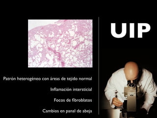 UIP
Patrón heterogéneo con áreas de tejido normal

                       Inﬂamación intersticial

                         Focos de ﬁbroblatos

                   Cambios en panal de abeja
 
