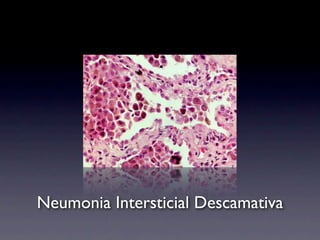 Neumonia Intersticial Descamativa
 