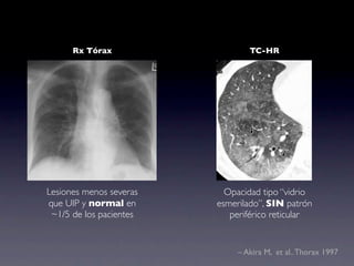 Rx Tórax                   TC-HR




Lesiones menos severas     Opacidad tipo “vidrio
que UIP y normal en      esmerilado”, SIN patrón
 ~1/5 de los pacientes      periférico reticular


                              – Akira M, et al.. Thorax 1997
 