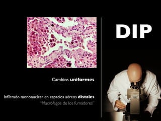 DIP

                          Cambios uniformes


Inﬁltrado mononuclear en espacios aéreos distales
                   “Macrófagos de los fumadores”
 