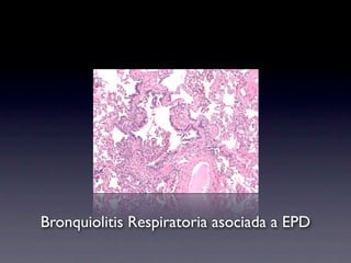 Bronquiolitis Respiratoria asociada a EPD
 