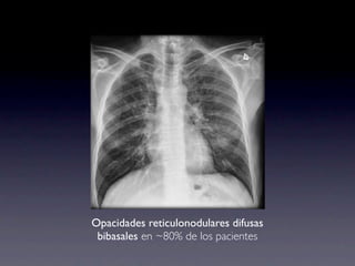 Opacidades reticulonodulares difusas
 bibasales en ~80% de los pacientes
 