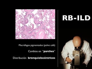 RB-ILD


    Macrófagos pigmentados (polvo café)

             Cambios en “parches”

Distribución bronquiolocéntricos
 