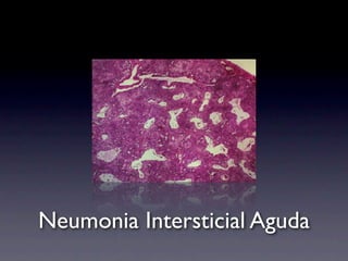 Neumonia Intersticial Aguda
 