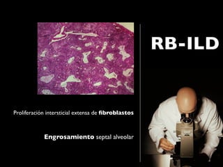 RB-ILD


Proliferación intersticial extensa de ﬁbroblastos



            Engrosamiento septal alveolar
 